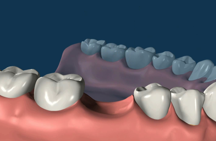 Corona Dental Implant