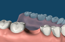 Corona Dental Implant