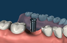 Corona Dental Implant