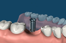 Corona Dental Implant