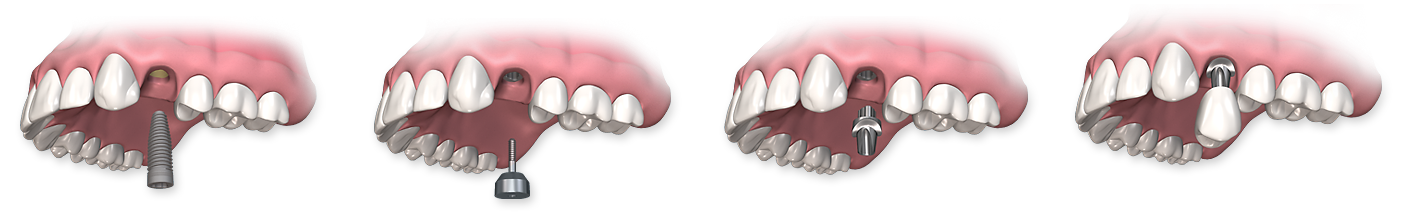 Corona Dental Implants