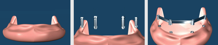 Implant Supported Removable Bar Overdenture