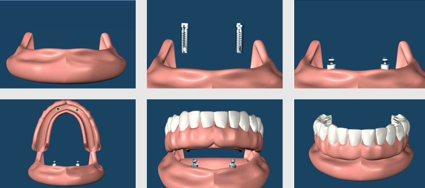 Implant Supported Removable Bar Overdenture