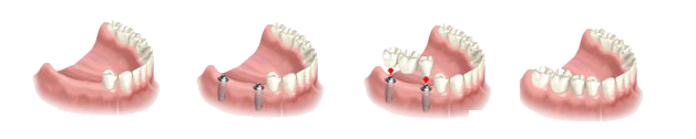 Corona Dental Implants