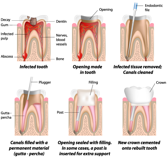 Corona Root Canals